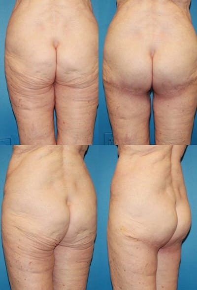 Infragluteal Thigh Lift Before & After Gallery - Patient 2395963 - Image 1