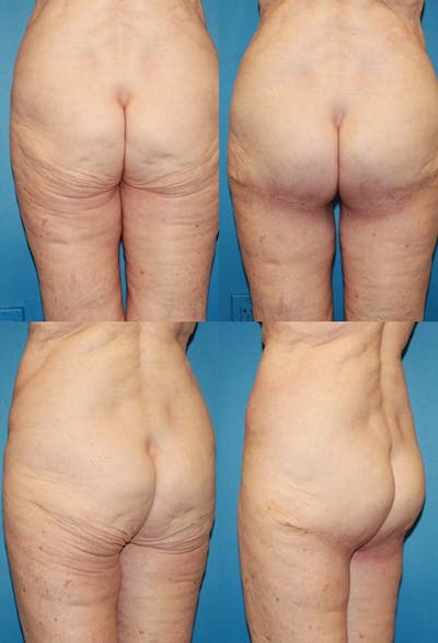 Infragluteal Thigh Lift