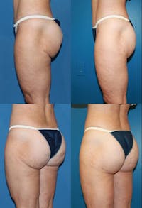 Infragluteal Thigh Lift Before & After Gallery - Patient 2395966 - Image 1