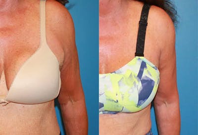 Arm Lift Before & After Gallery - Patient 2161804 - Image 1