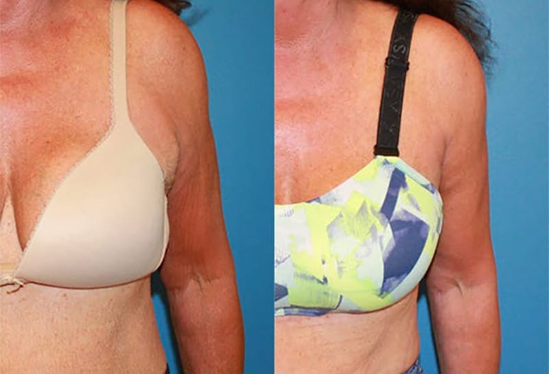 Arm Lift Before & After Gallery - Patient 306412 - Image 1