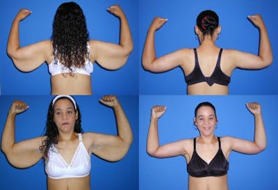 Arm Lift Before & After Gallery - Patient 397116 - Image 1