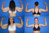 Arm Lift Before & After Gallery - Patient 2161808 - Image 1