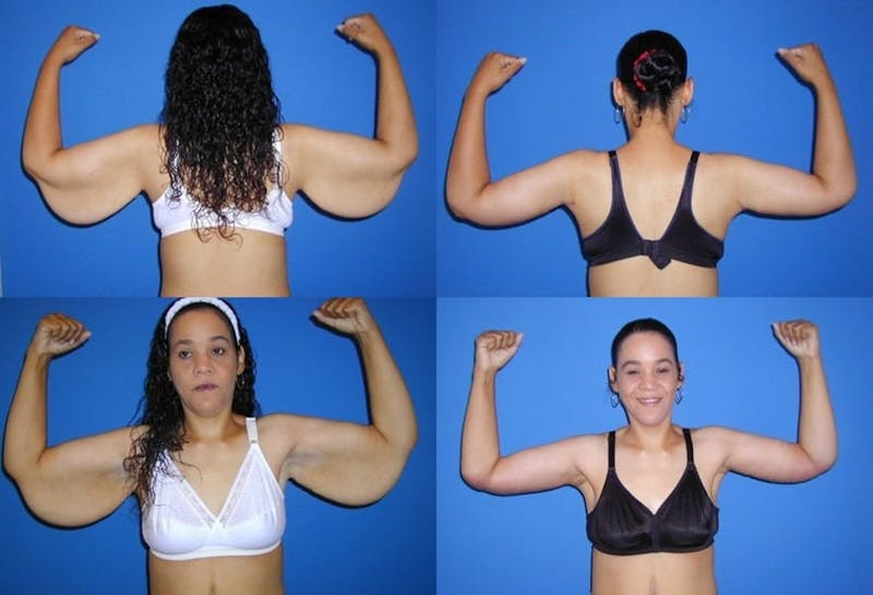 Arm Lift Before & After Gallery - Patient 397116 - Image 1