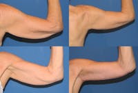 Arm Lift Before & After Gallery - Patient 2161809 - Image 1