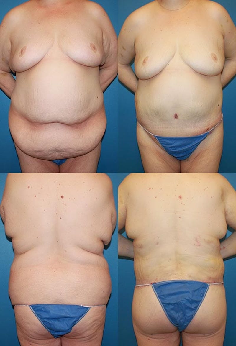Body Lift / Thigh Lift Before & After Gallery - Patient 2161817 - Image 1
