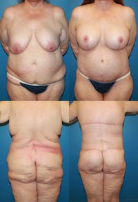 Body Lift / Thigh Lift Before & After Gallery - Patient 2161818 - Image 1