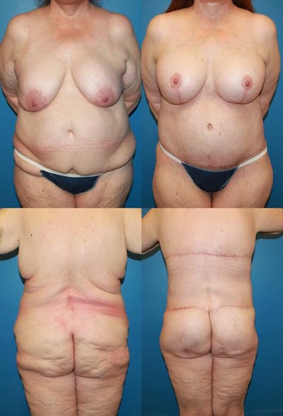 Body Lift / Thigh Lift Gallery - Patient 2161818 - Image 1