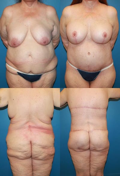 Body Lift / Thigh Lift Before & After Gallery - Patient 2161818 - Image 1