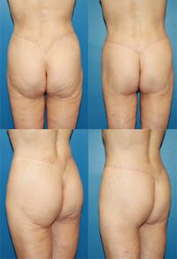 Body Lift / Thigh Lift Before & After Gallery - Patient 2161819 - Image 1
