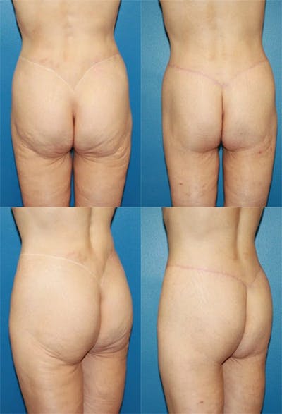 Body Lift / Thigh Lift Before & After Gallery - Patient 2161819 - Image 1