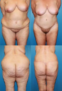 Body Lift / Thigh Lift Before & After Gallery - Patient 2161821 - Image 1