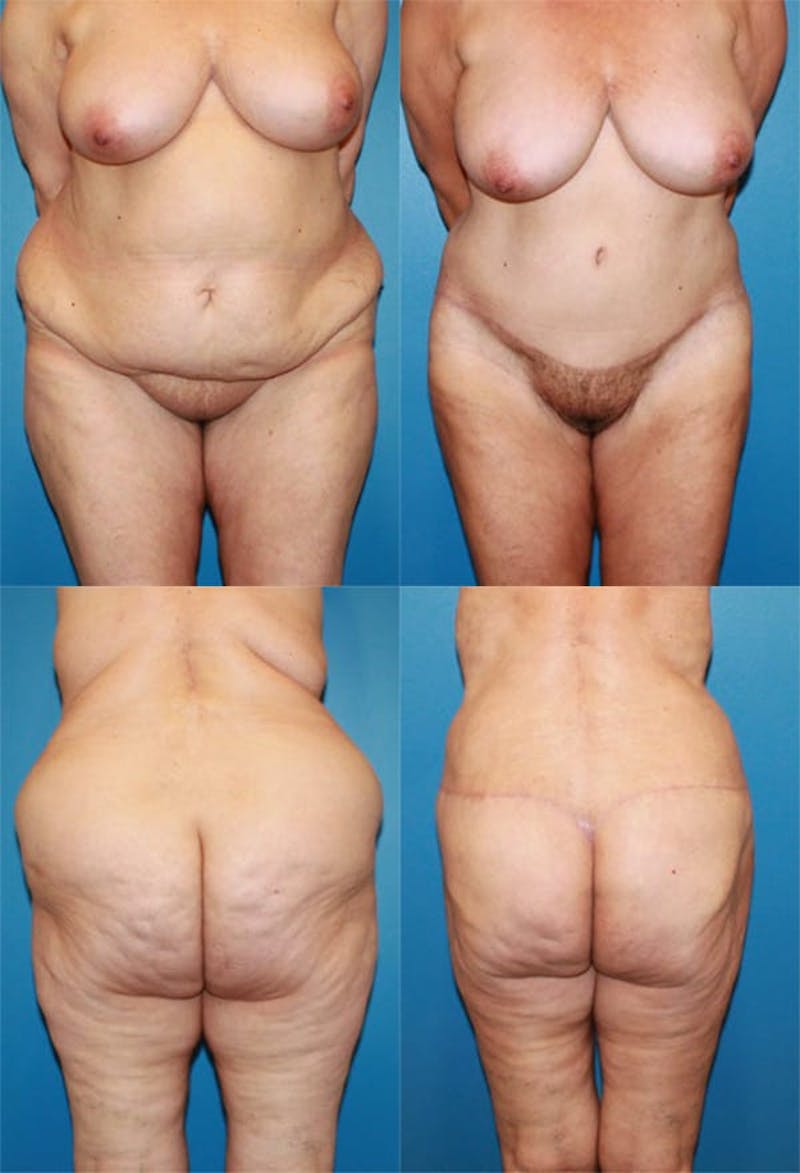 Body Lift / Thigh Lift Before & After Gallery - Patient 2161821 - Image 1