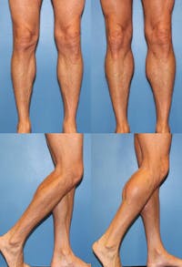 Calf Augmentation Before & After Gallery - Patient 2161824 - Image 1