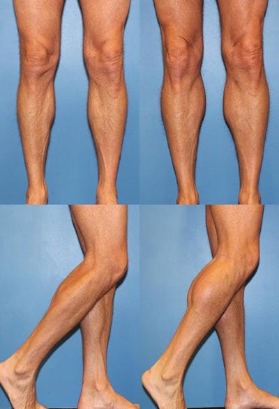 Calf Augmentation