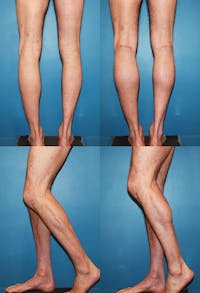 Calf Augmentation Before & After Gallery - Patient 2161826 - Image 1