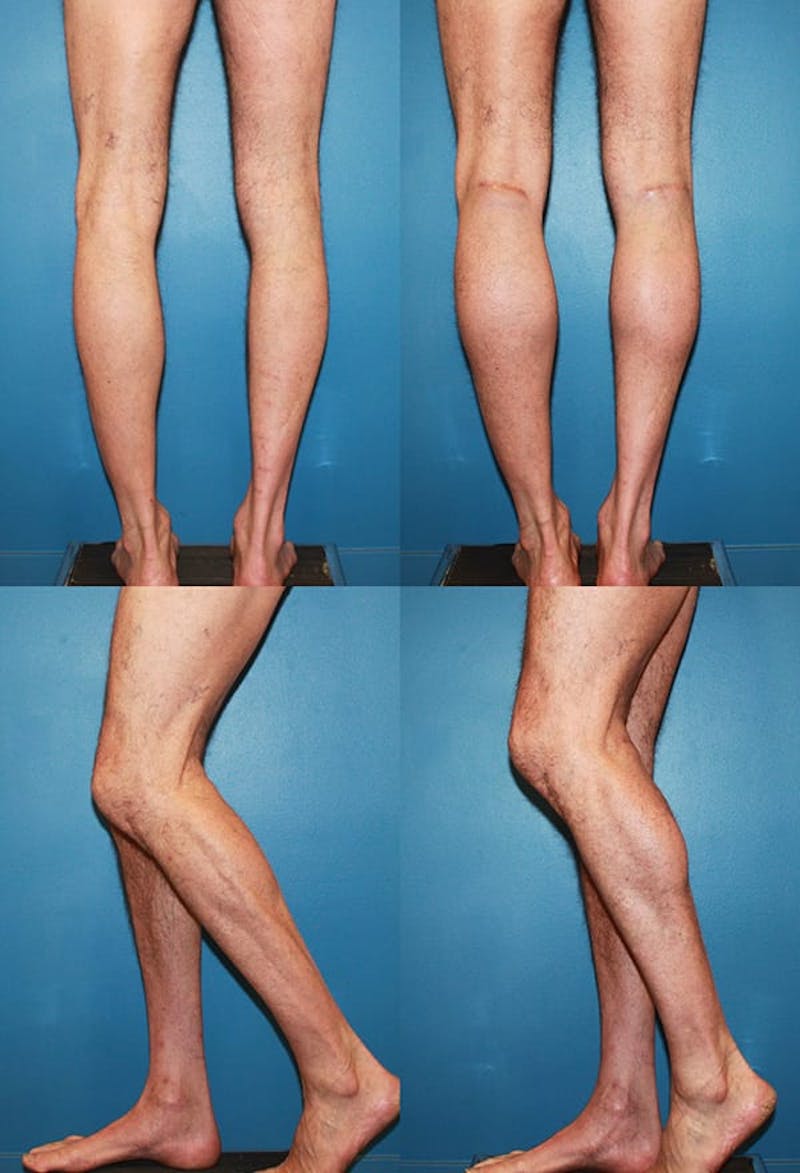 Calf Augmentation Before & After Gallery - Patient 2161826 - Image 1