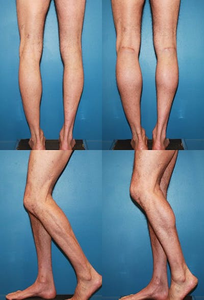 Calf Augmentation Before & After Gallery - Patient 2161826 - Image 1