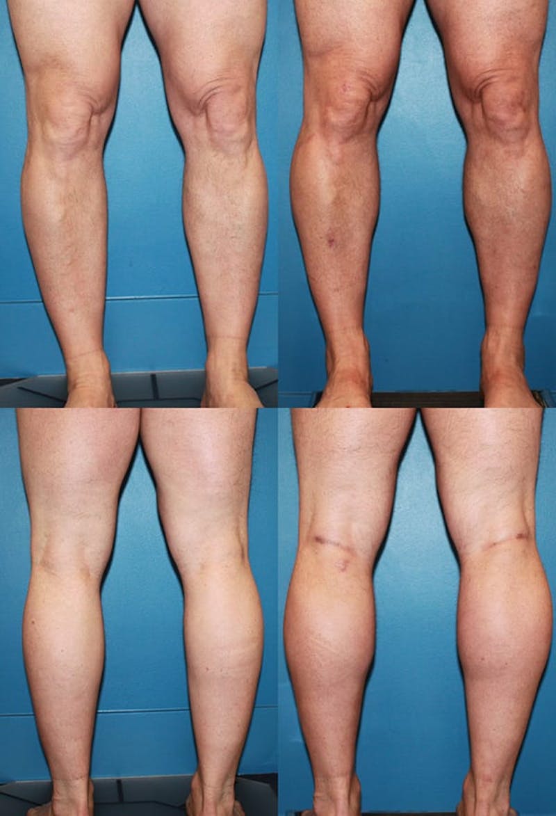 Calf Augmentation Before & After Gallery - Patient 2161827 - Image 1