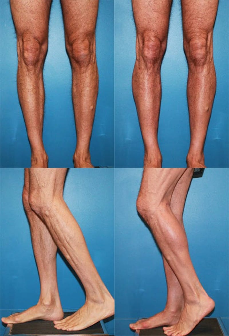 Calf Augmentation Before & After Gallery - Patient 2161828 - Image 1