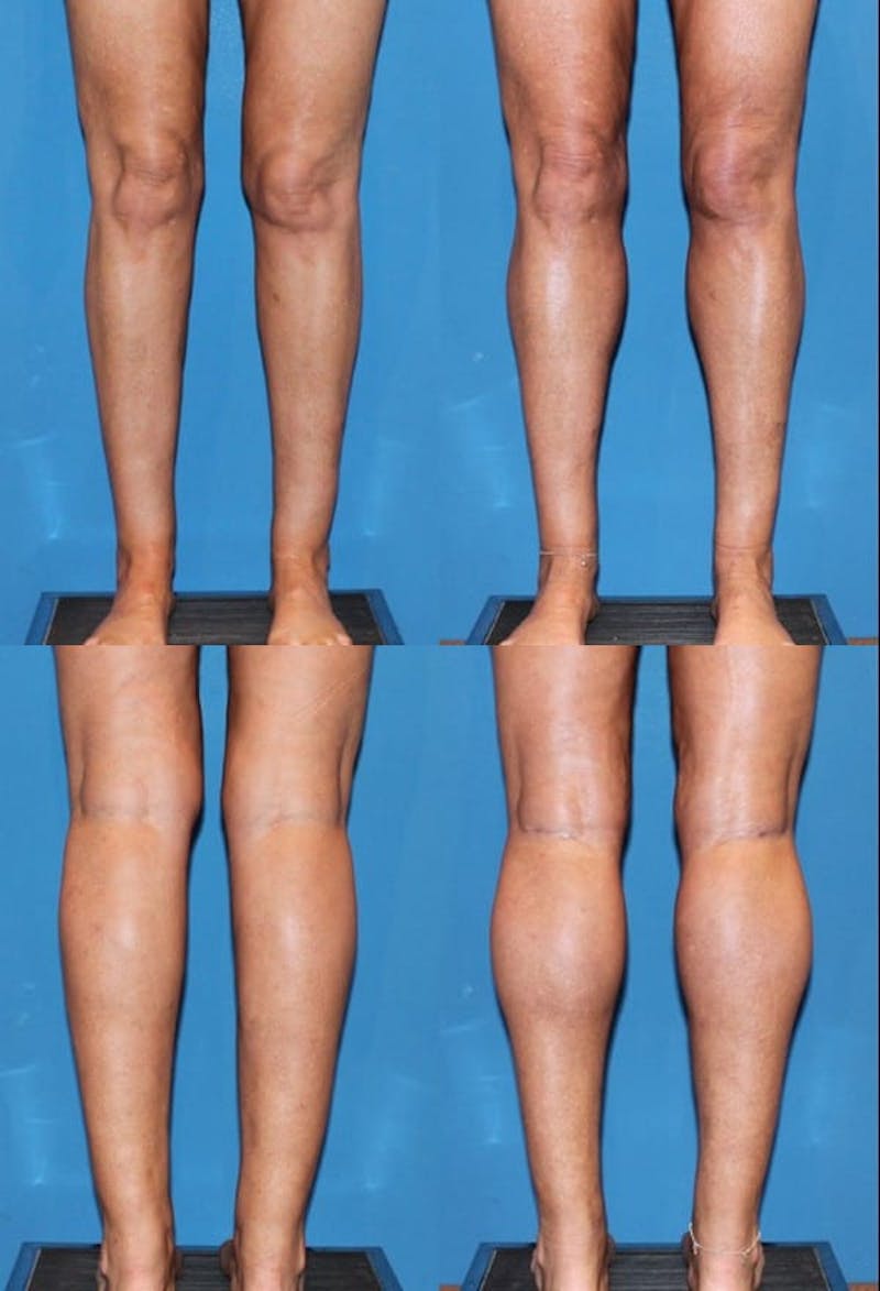 Calf Augmentation Before & After Gallery - Patient 2161830 - Image 1
