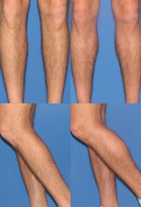 Calf Augmentation Before & After Gallery - Patient 2161831 - Image 1