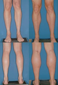 Calf Augmentation Before & After Gallery - Patient 2161834 - Image 1