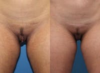 Labiaplasty Before & After Gallery - Patient 2161843 - Image 1