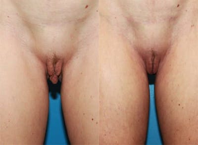 Labiaplasty Before & After Gallery - Patient 2161847 - Image 1