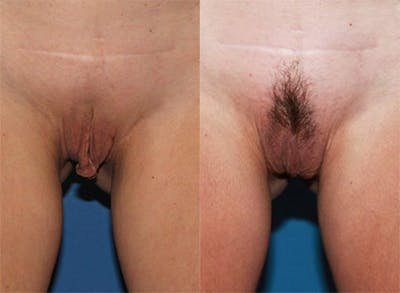 Labiaplasty Before & After Gallery - Patient 2161848 - Image 1