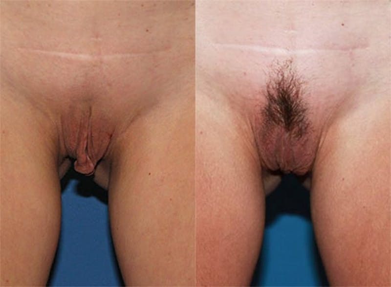 Labiaplasty Before & After Gallery - Patient 2161848 - Image 1