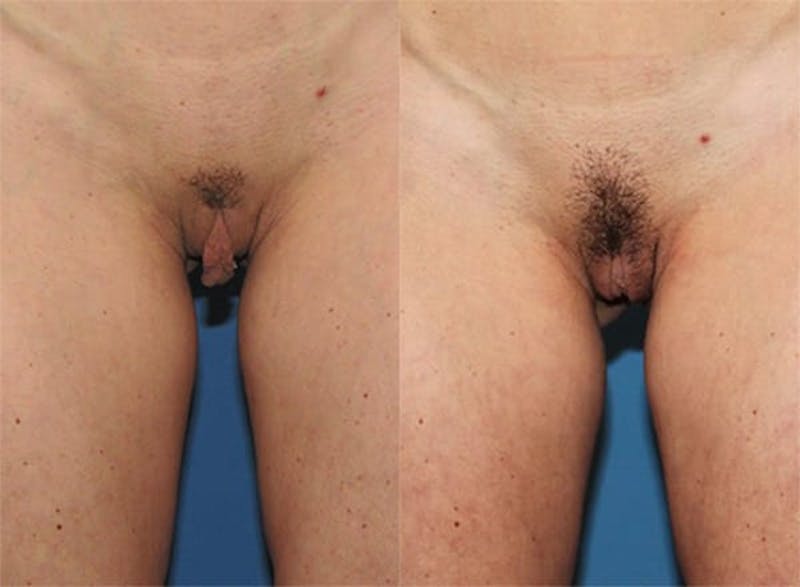 Labiaplasty Before & After Gallery - Patient 2161849 - Image 1