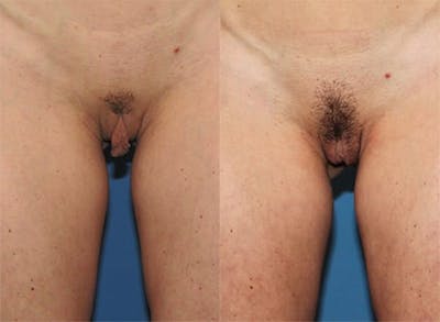 Labiaplasty Before & After Gallery - Patient 2161849 - Image 1