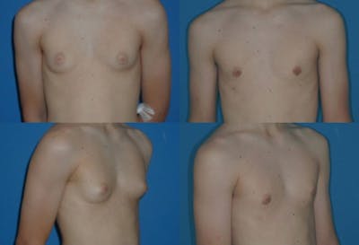 Male Breast Reduction