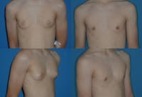 Male Breast Reduction/Gynecomastia Before & After Gallery - Patient 2161880 - Image 1