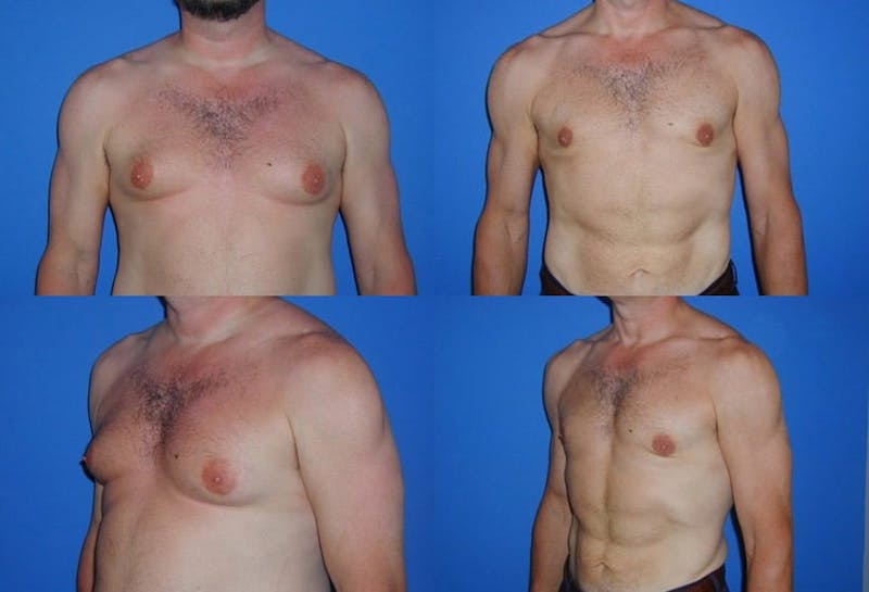 Male Breast Reduction/Gynecomastia Gallery - Patient 2161881 - Image 1