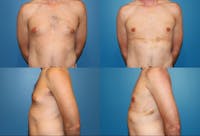 Male Breast Reduction/Gynecomastia Before & After Gallery - Patient 2161882 - Image 1