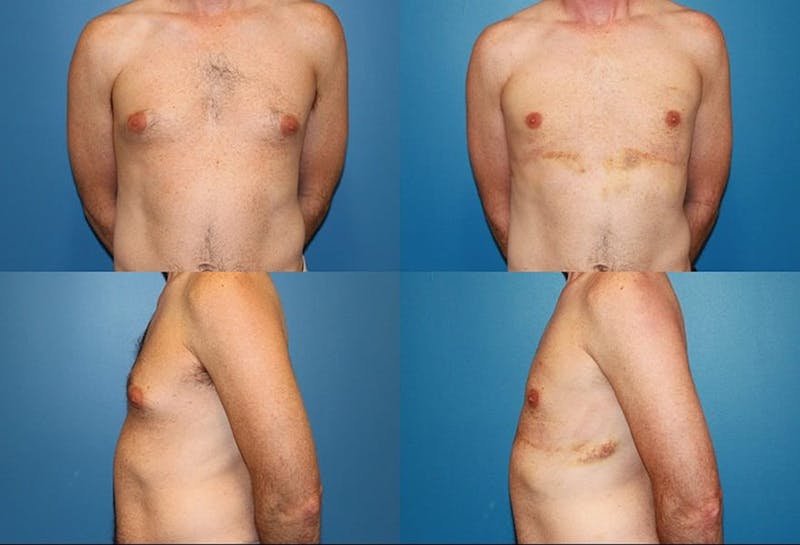 Male Breast Reduction/Gynecomastia Before & After Gallery - Patient 2161882 - Image 1