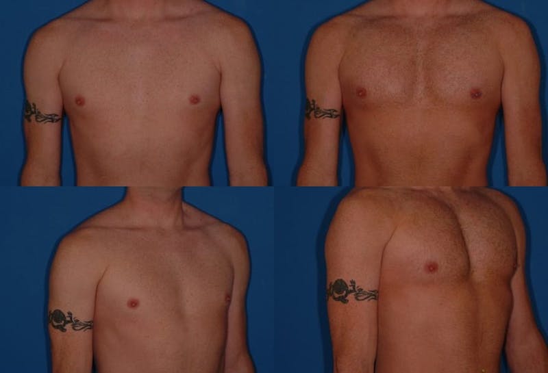 Male Pectoral Augmentation Before & After Gallery - Patient 2161884 - Image 1