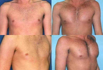 Male Pectoral Augmentation Before & After Gallery - Patient 2161885 - Image 1