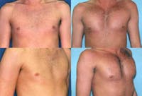 Male Pectoral Augmentation Before & After Gallery - Patient 2161885 - Image 1