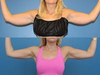 Coolsculpting Before & After Gallery - Patient 2161905 - Image 1