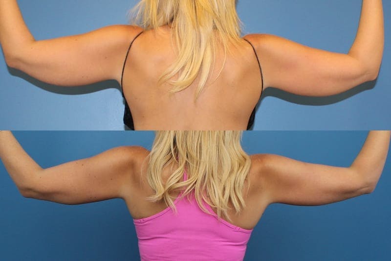 Coolsculpting Elite Before & After Gallery - Patient 2161905 - Image 2