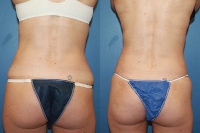 Coolsculpting Elite Before & After Gallery - Patient 2161907 - Image 1