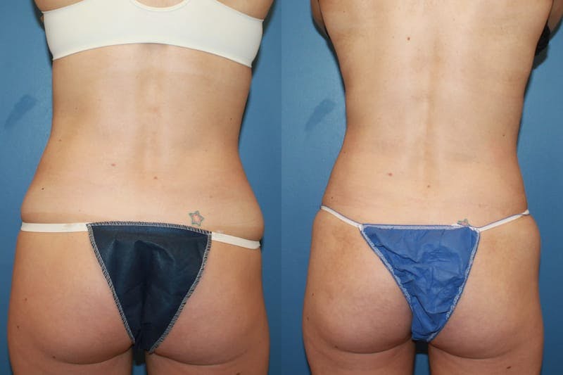 Coolsculpting Before & After Gallery - Patient 2161907 - Image 1