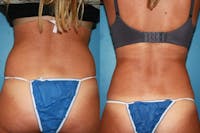 Coolsculpting Elite Before & After Gallery - Patient 2161908 - Image 1
