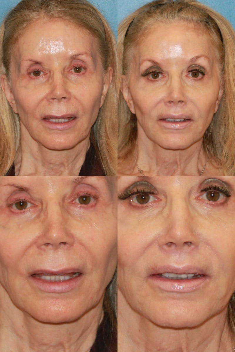 Lip Lift Before & After Gallery - Patient 2161910 - Image 1