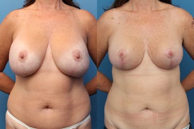 Liposuction Before & After Gallery - Patient 2161913 - Image 1