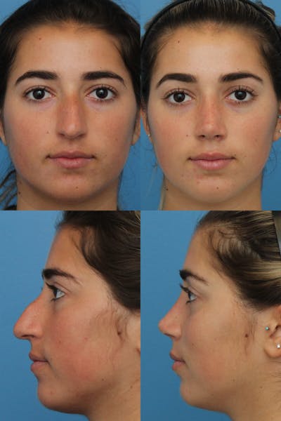 Rhinoplasty Before & After Gallery - Patient 2162051 - Image 1