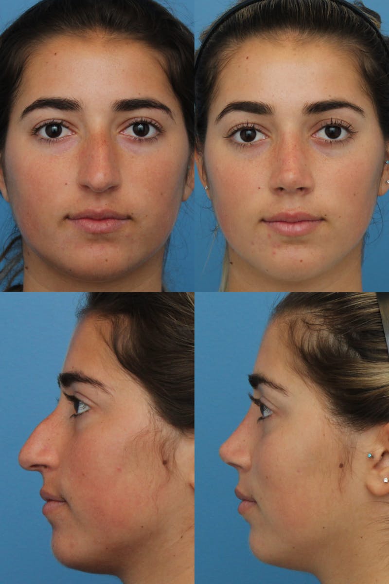 Rhinoplasty Before & After Gallery - Patient 2162051 - Image 1
